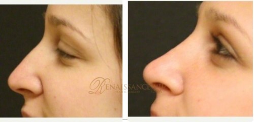 25 34 year old woman treated with Rhinoplasty 3